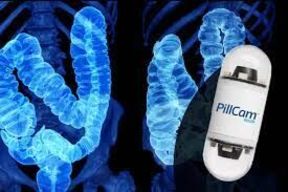 استفاده از کپسول دوربین‌دار برای تشخیص سرطان روده بزرگ